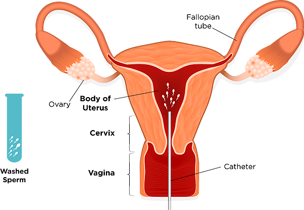iui