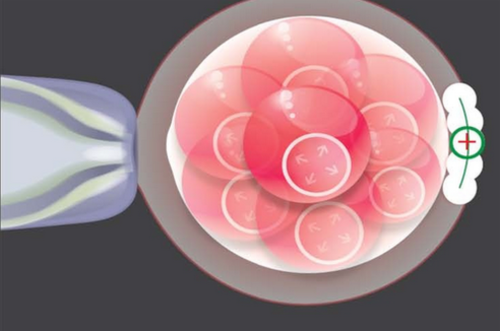 laser-assisted-hatching